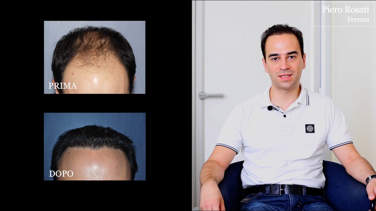 Trapianto di capelli: la testimonianza di Federico